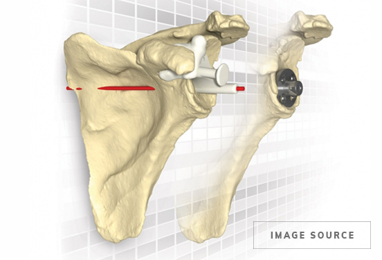 Patient Specific Joint Replacement DJO Matchpoint