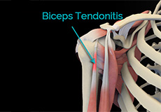 Proximal Biceps Tenodesis