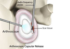 Capsular Release