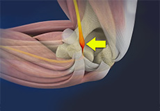 Cubital Tunnel Syndrome (Ulnar Nerve Entrapment)