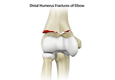 ORIF of the Distal Humerus Fractures