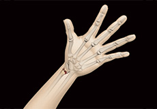 ORIF of Distal Radius Fracture