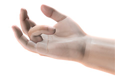 Dupuytren's Contracture