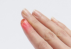 Fingertip Injuries