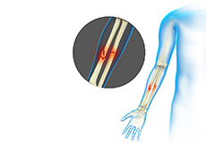 Adult Forearm Fractures