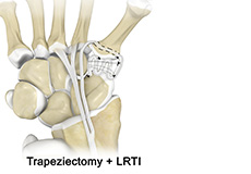LRTI (Ligament Reconstruction and Tendon Interposition) for Thumb CMC Arthritis