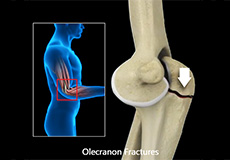 ORIF of the Olecranon Fractures