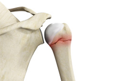 Proximal Humerus Fractures