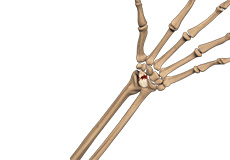 Scaphoid Facture