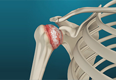 Arthritis of the Shoulder