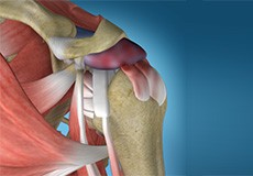 Shoulder Impingement