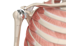 Total Shoulder Replacement