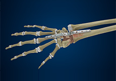 Total Wrist Arthrodesis